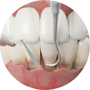 Mir Implant System image3